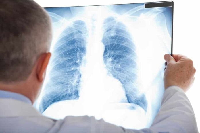 computed radiography